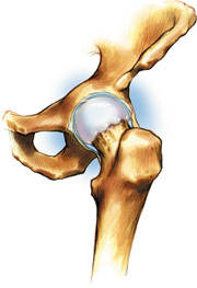 arthrosh1